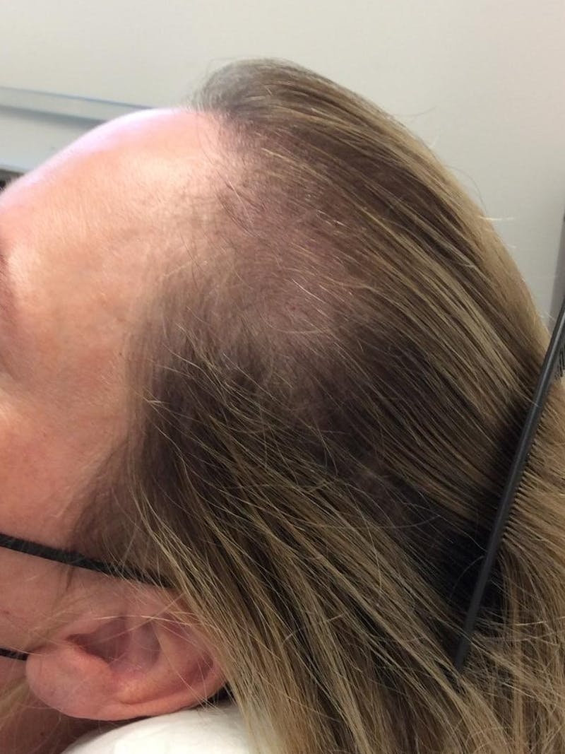 Low Level Laser Therapy Before & After Gallery - Patient 368377 - Image 1