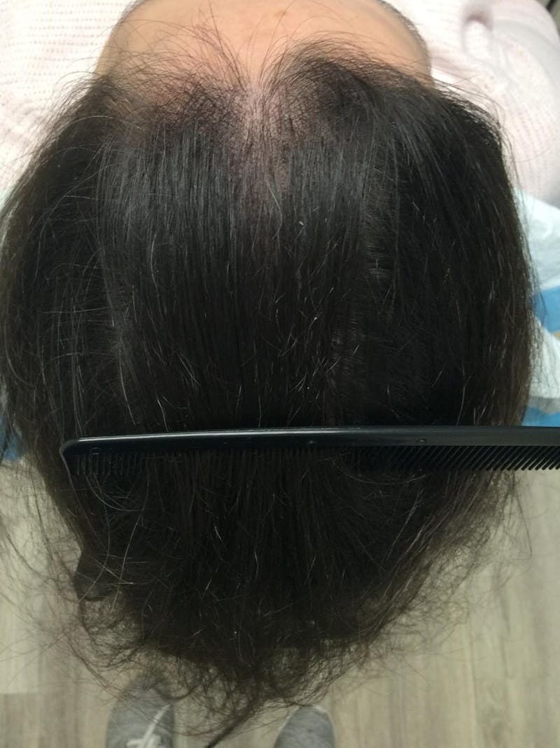 Low Level Laser Therapy Before & After Gallery - Patient 166753 - Image 2