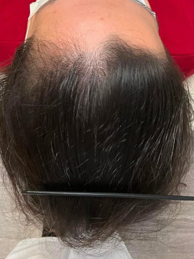 Optimal Platelet Concentration™ Therapy Before & After Gallery - Patient 391115 - Image 1