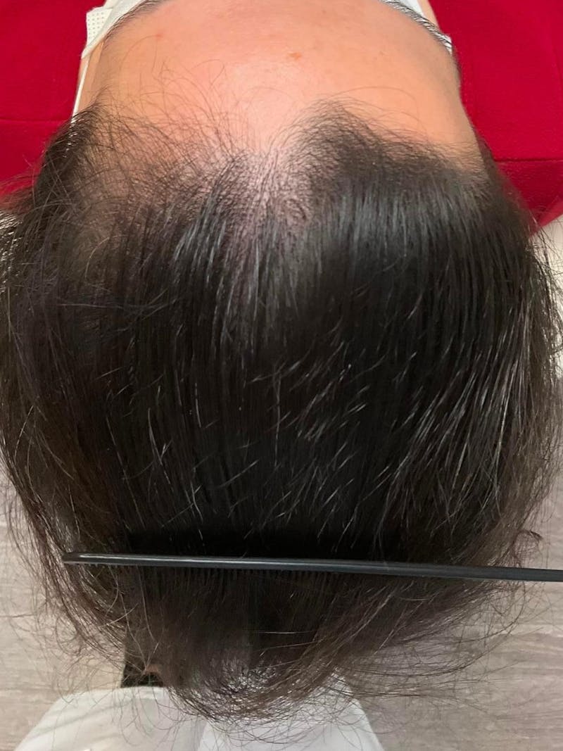Low Level Laser Therapy Before & After Gallery - Patient 166753 - Image 1