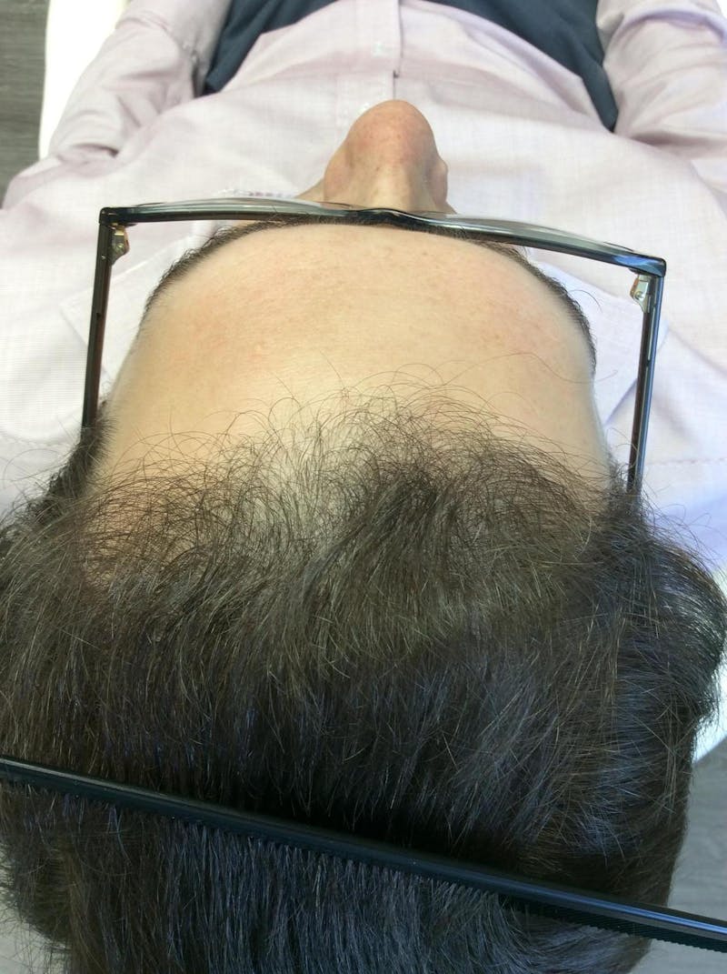Male Non-Surgical Before & After Gallery - Patient 325961 - Image 1