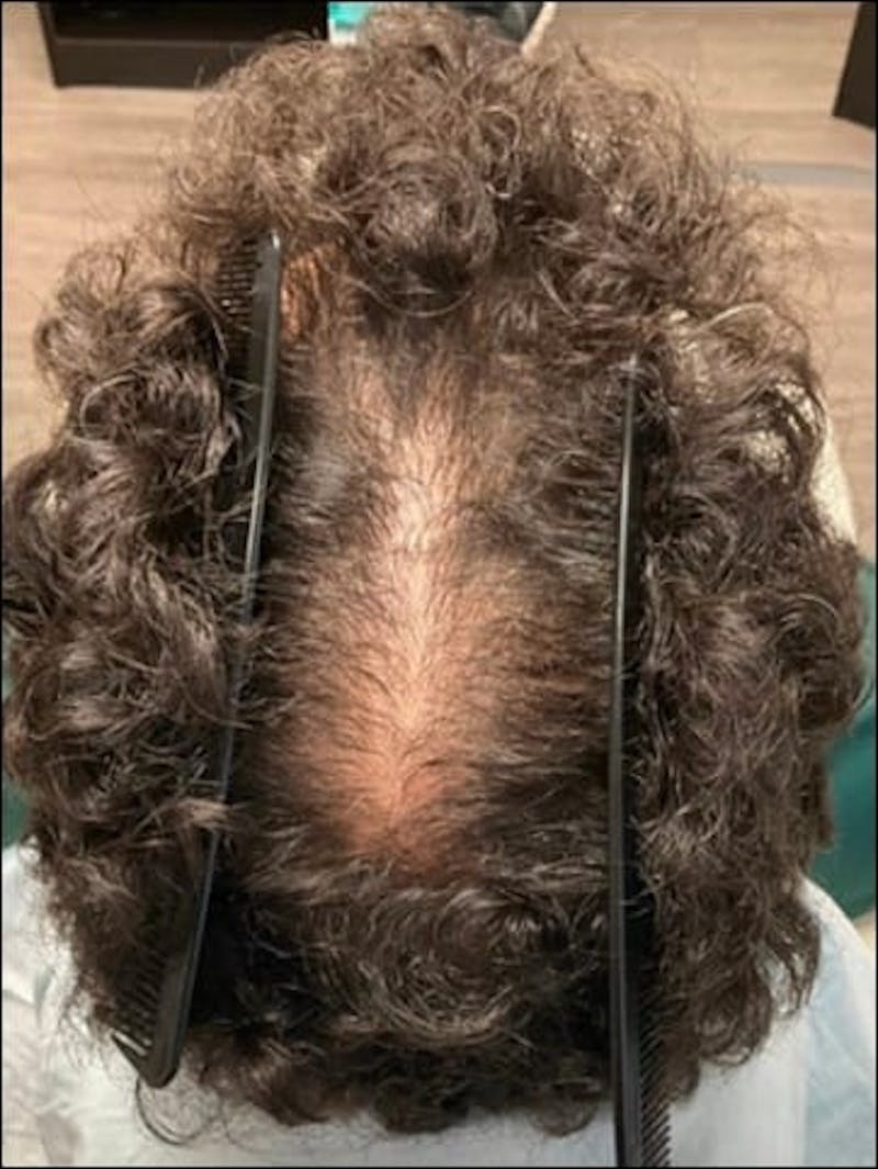 Male Non-Surgical Before & After Gallery - Patient 416242 - Image 2