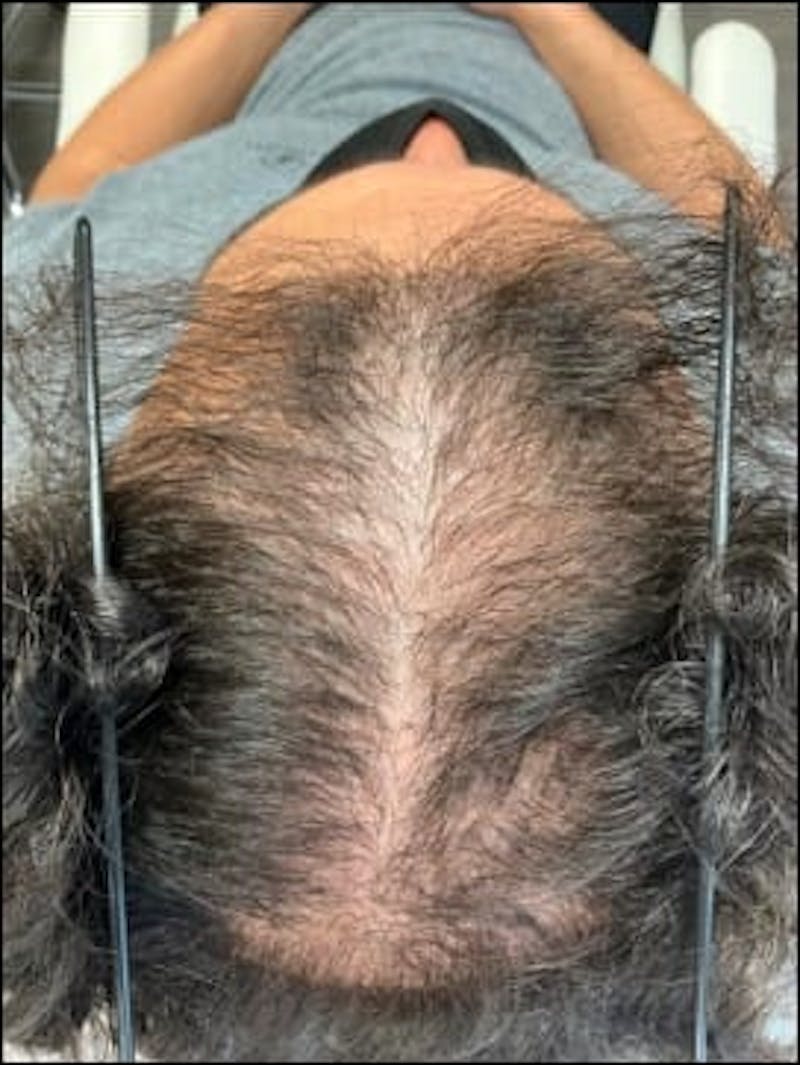 Male Non-Surgical Before & After Gallery - Patient 416242 - Image 1