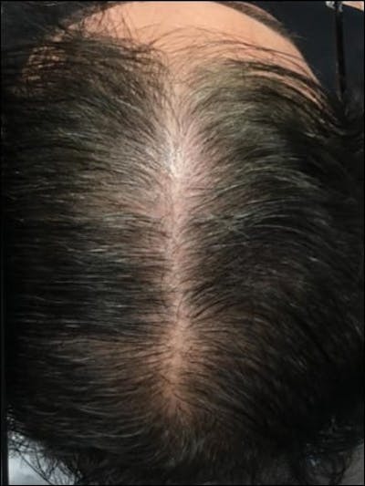 Male Non-Surgical Before & After Gallery - Patient 111600 - Image 2