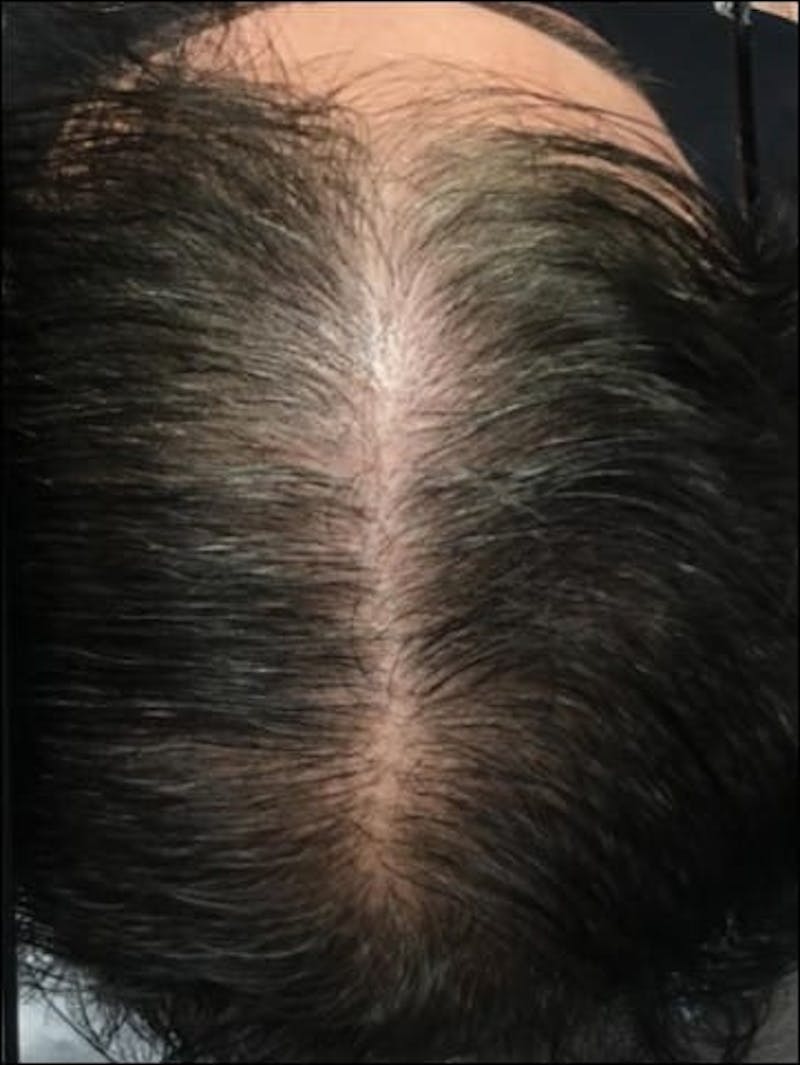 Male Non-Surgical Before & After Gallery - Patient 111600 - Image 2