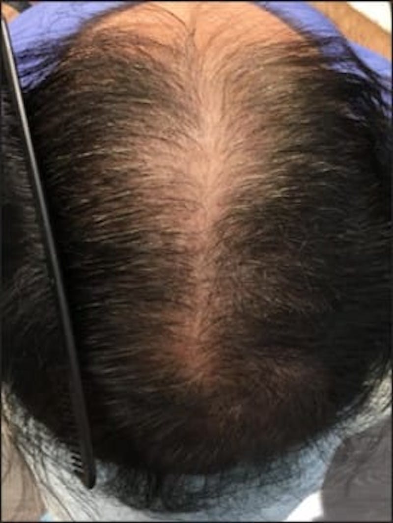 Male Non-Surgical Before & After Gallery - Patient 111600 - Image 1