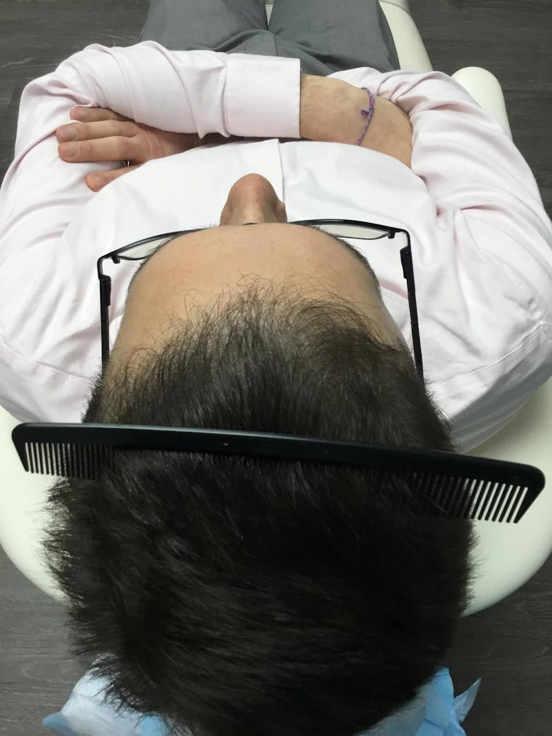 Male Non-Surgical Before & After Gallery - Patient 325961 - Image 2