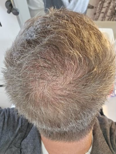 FUE Hair Transplant Before & After Gallery - Patient 165513 - Image 2