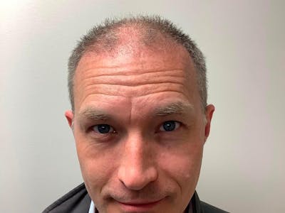 male hair loss patient