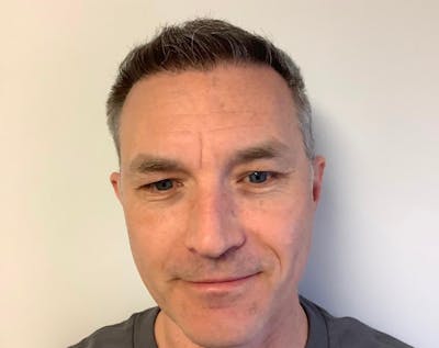 male hair transplant patient