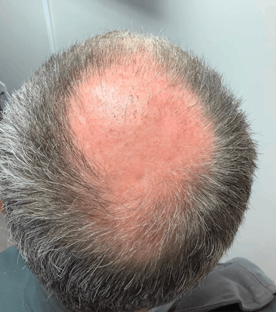 FUE Hair Transplant Before & After Gallery - Patient 165513 - Image 1