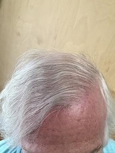FUE Hair Transplant Before & After Gallery - Patient 120857 - Image 2