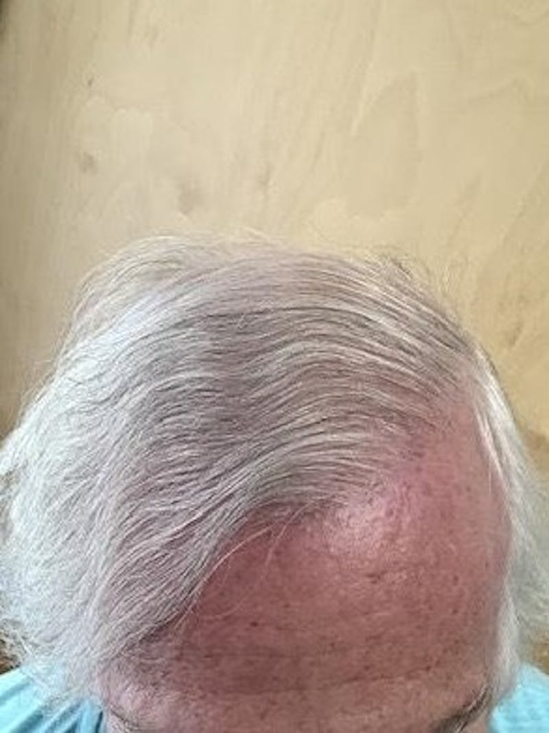 FUE Hair Transplant Before & After Gallery - Patient 120857 - Image 2