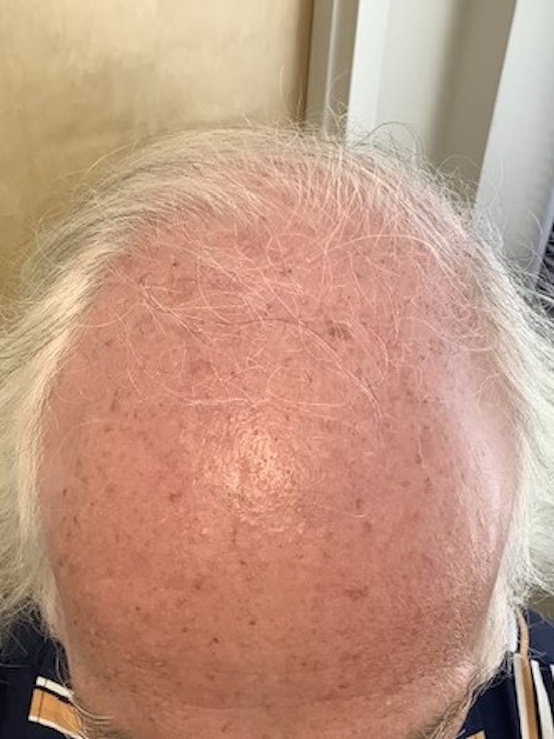 FUE Hair Transplant Before & After Gallery - Patient 120857 - Image 1