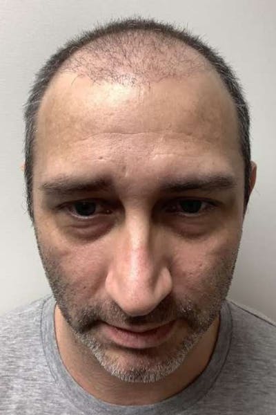 FUE Hair Transplant Before & After Gallery - Patient 303824 - Image 1