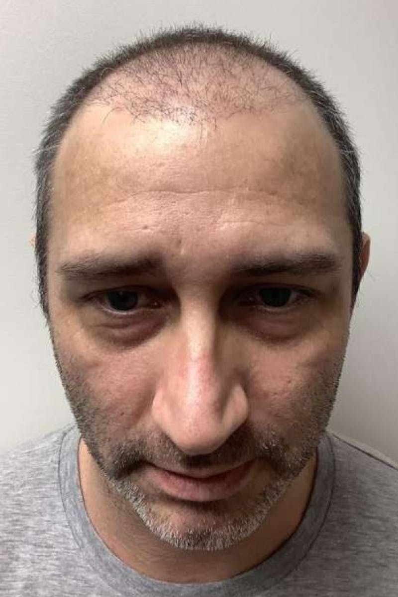 FUE Hair Transplant Before & After Gallery - Patient 303824 - Image 1