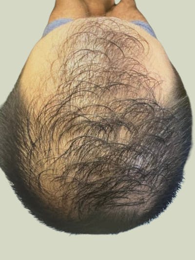 Male Hair Transplants Before & After Gallery - Patient 332253 - Image 1