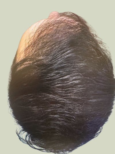Male Hair Transplants Before & After Gallery - Patient 332253 - Image 2