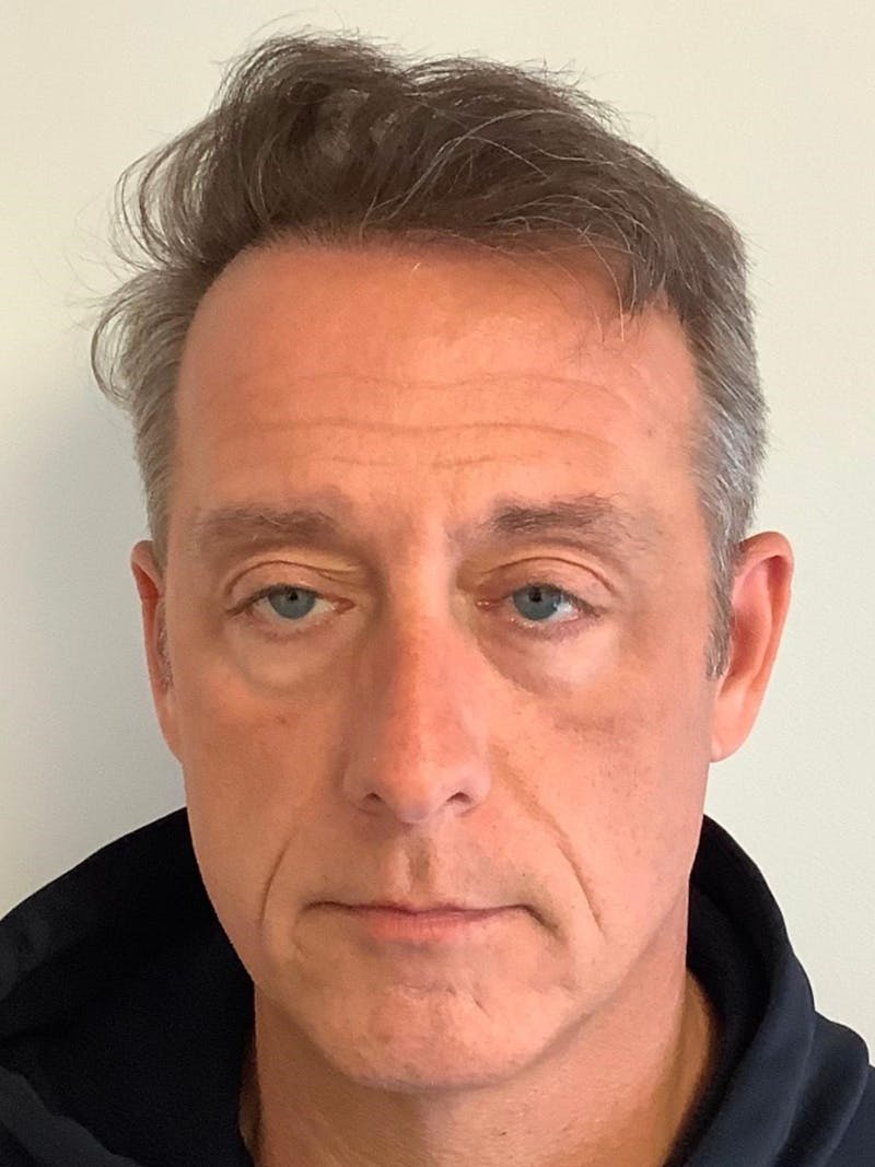 Male Hair Transplants Before & After Gallery - Patient 426501 - Image 1