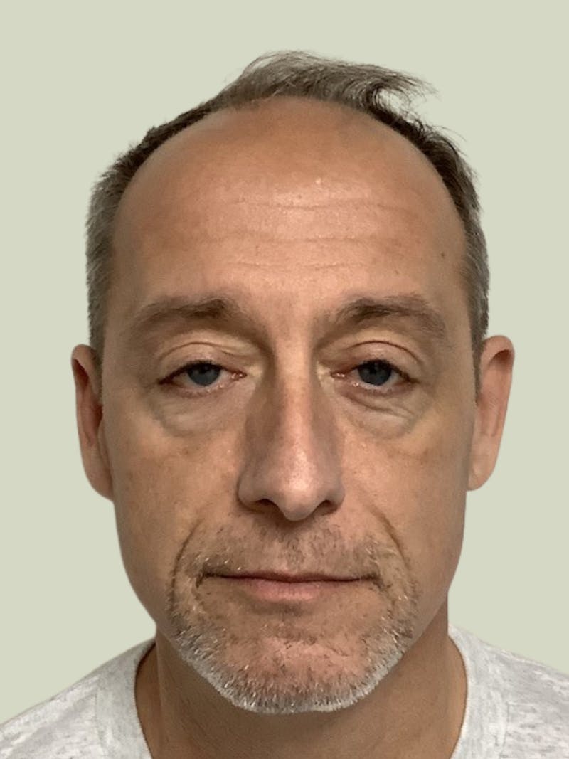 Male Hair Transplants Before & After Gallery - Patient 426501 - Image 2