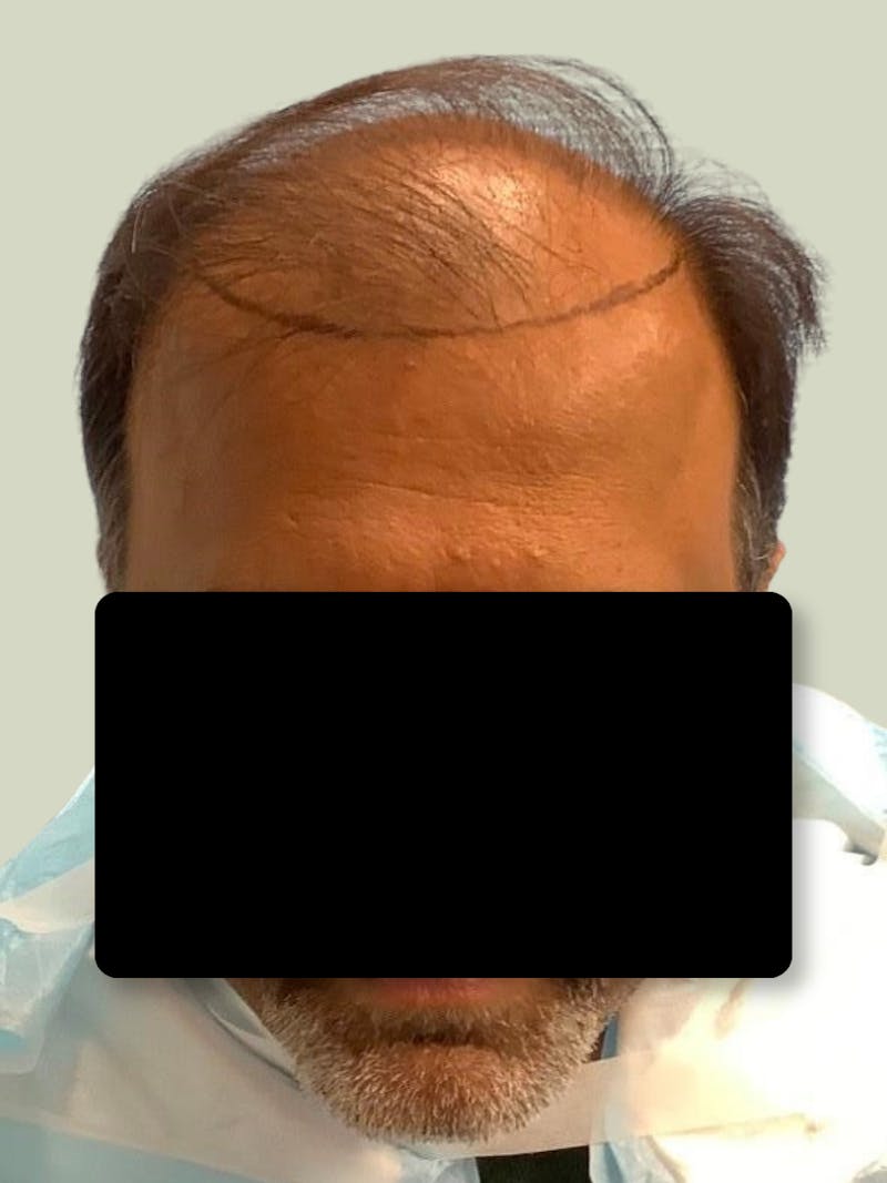 Male Hair Transplants Before & After Gallery - Patient 780802 - Image 2