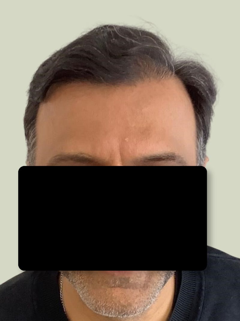 Male Hair Transplants Before & After Gallery - Patient 780802 - Image 1
