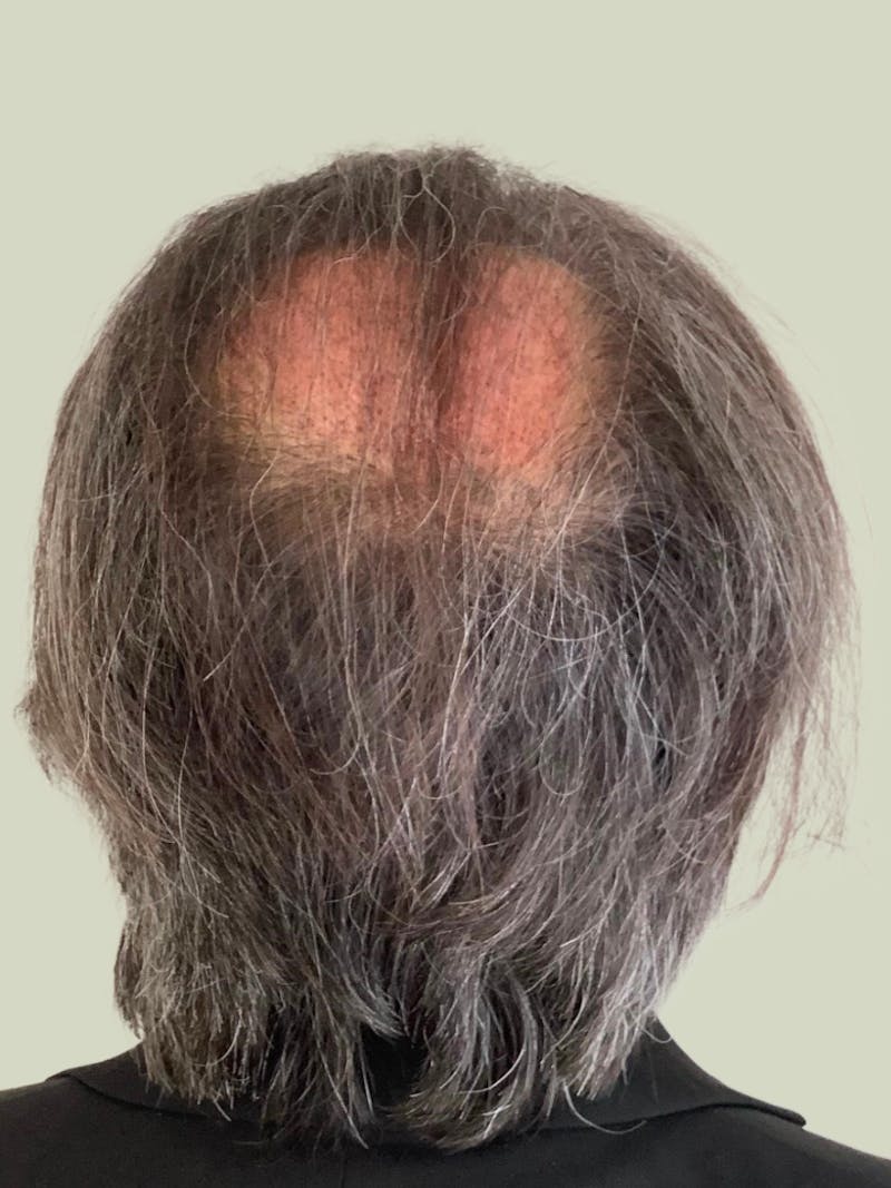 Male Hair Transplants Before & After Gallery - Patient 420369 - Image 2