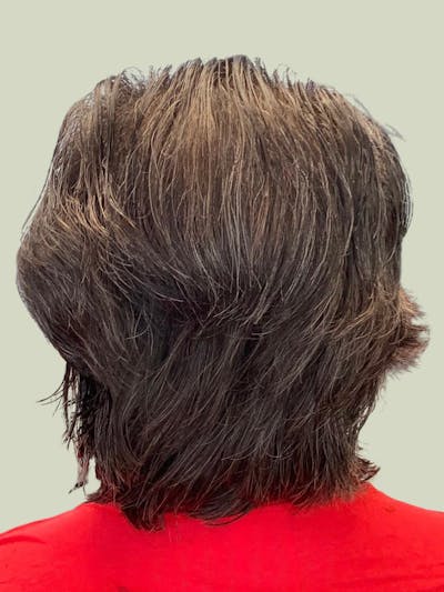 Male Hair Transplants Before & After Gallery - Patient 420369 - Image 2