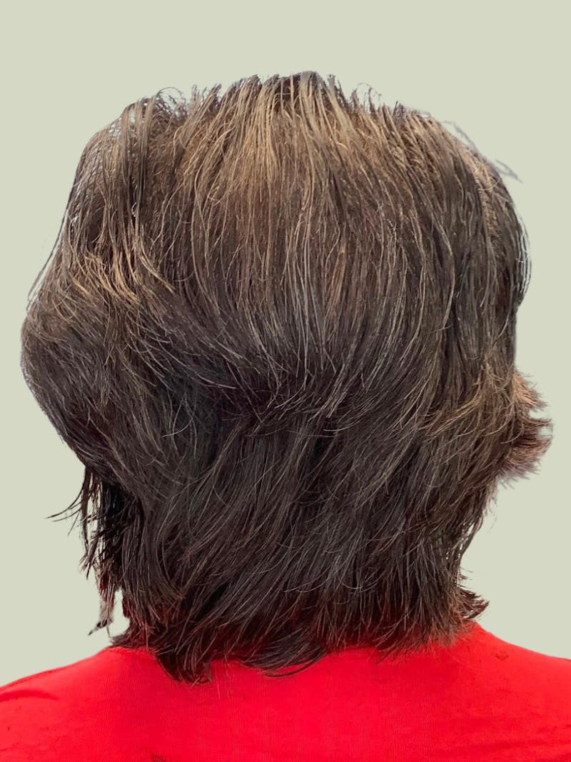 Male Hair Transplants Before & After Gallery - Patient 420369 - Image 1