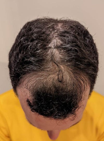 patient with hair loss
