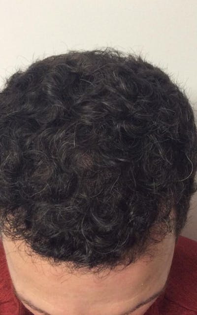 patient after hair procedure