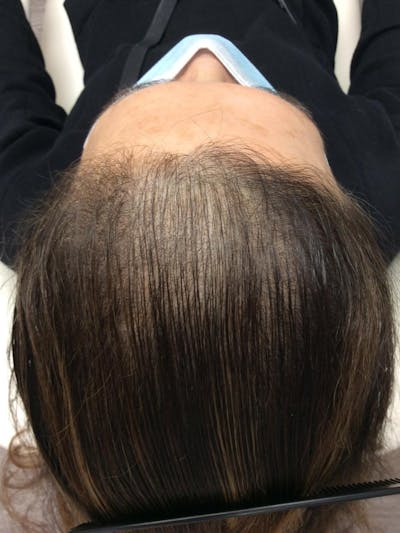 Androgenic Alopecia Before & After Gallery - Patient 754135 - Image 1