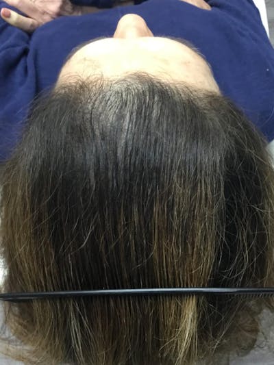 Androgenic Alopecia Before & After Gallery - Patient 754135 - Image 2