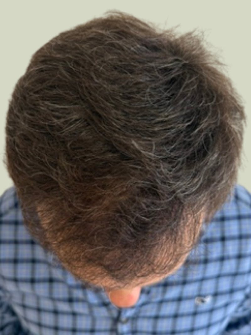 Male Hair Transplants Before & After Gallery - Patient 152152 - Image 2
