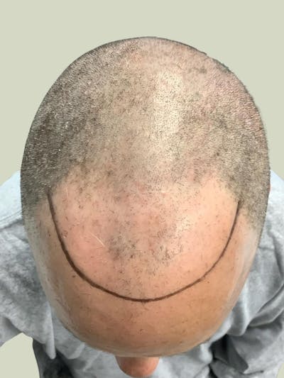 Male Hair Transplants Before & After Gallery - Patient 152152 - Image 1