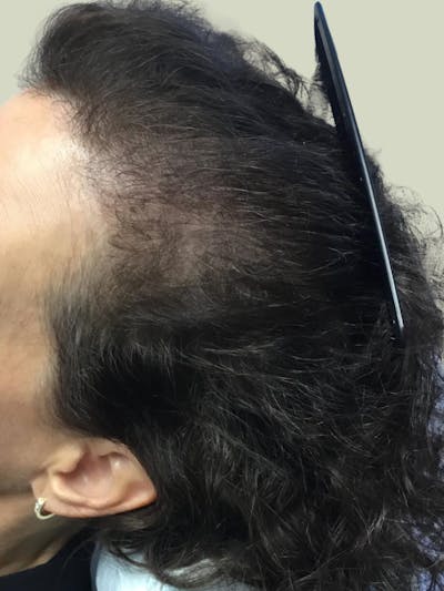 Painless PRP Before & After Gallery - Patient 323572 - Image 1
