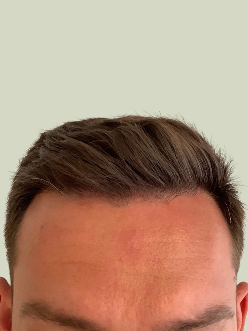 Male Hair Transplants Before & After Gallery - Patient 302386 - Image 2