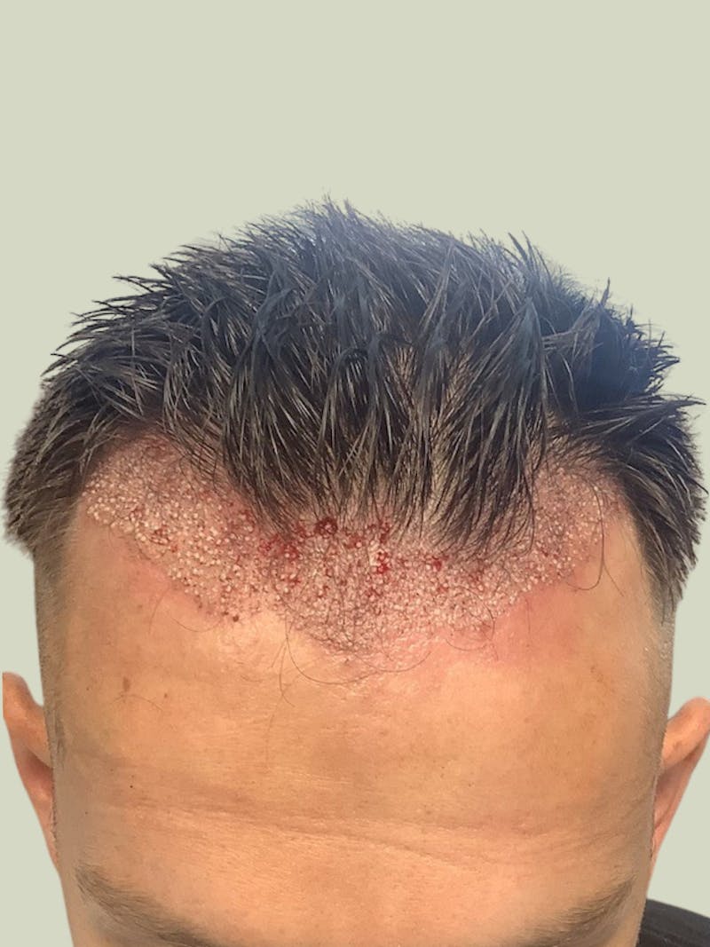 Male Hair Transplants Before & After Gallery - Patient 302386 - Image 1