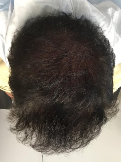 FUE Hair Transplant Before & After Gallery - Patient 140273 - Image 2