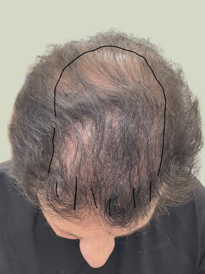 FUE Hair Transplant Before & After Gallery - Patient 140273 - Image 1