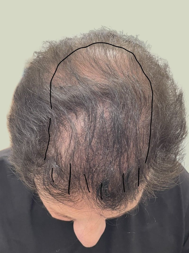 Male Hair Transplants Before & After Gallery - Patient 251203 - Image 1