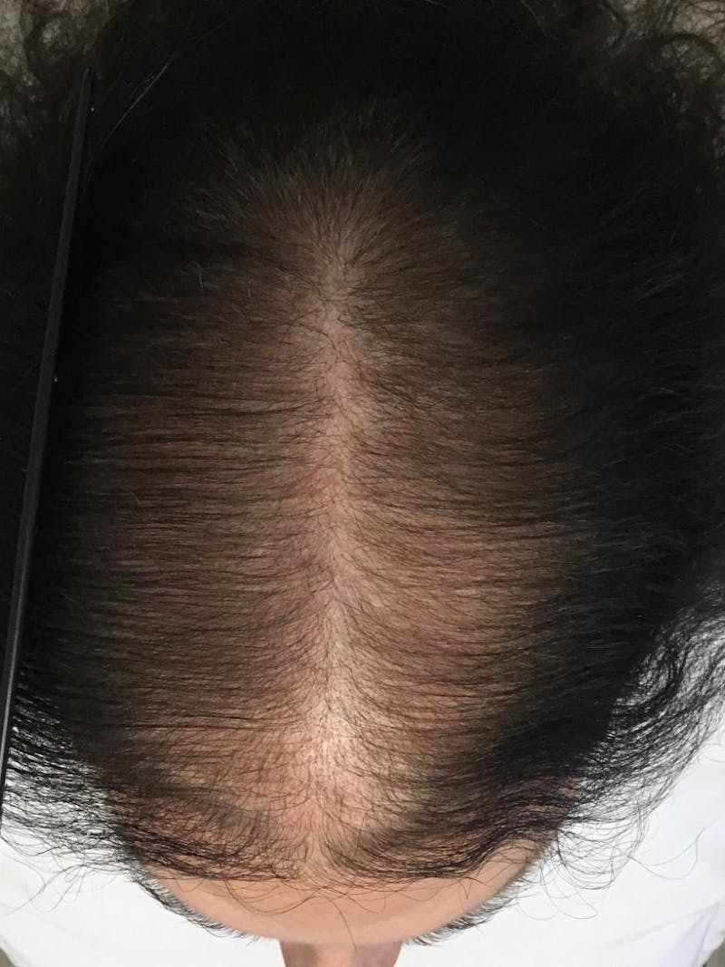 Androgenic Alopecia Before & After Gallery - Patient 125940 - Image 2