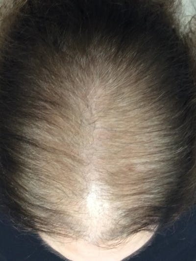 Painless PRP Before & After Gallery - Patient 221676 - Image 1