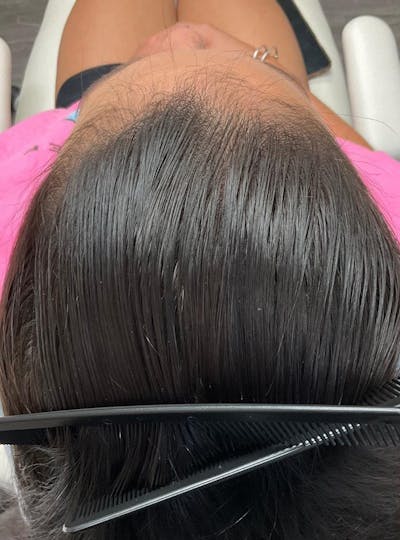 Low Level Laser Therapy Before & After Gallery - Patient 582547 - Image 2