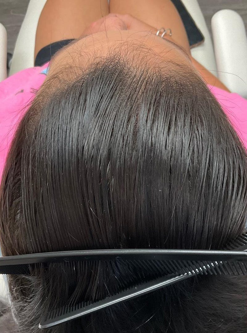 Low Level Laser Therapy Before & After Gallery - Patient 582547 - Image 2