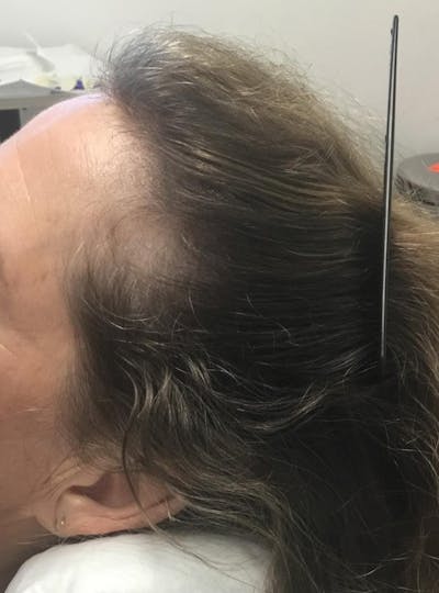 Low Level Laser Therapy Before & After Gallery - Patient 407428 - Image 1