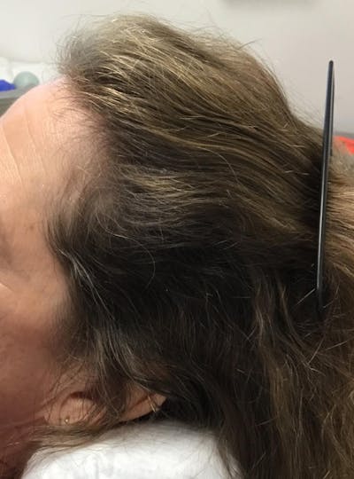 Low Level Laser Therapy Before & After Gallery - Patient 407428 - Image 2