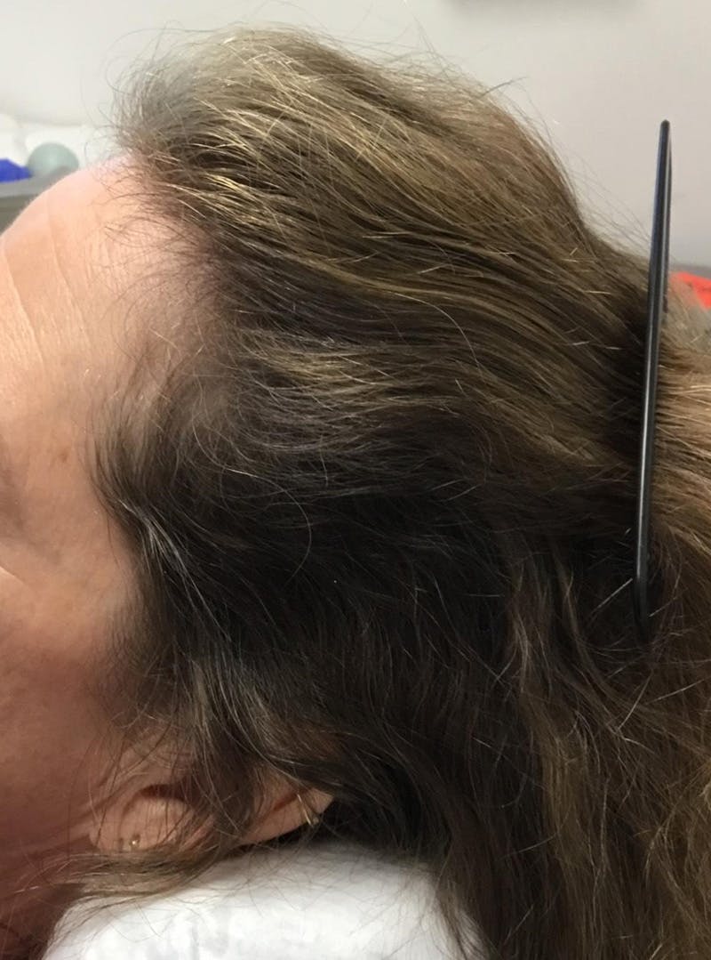 Androgenic Alopecia Before & After Gallery - Patient 385041 - Image 2