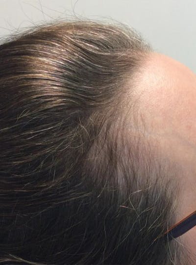 Painless PRP Before & After Gallery - Patient 293111 - Image 1