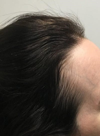 Painless PRP Before & After Gallery - Patient 293111 - Image 2